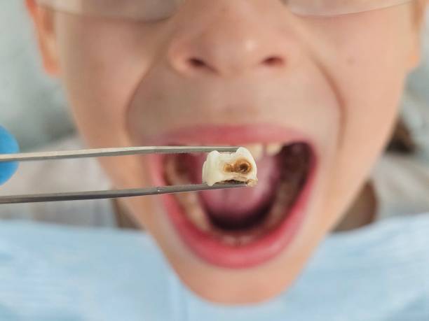 Best Emergency Tooth Extraction in Ocean City, NJ